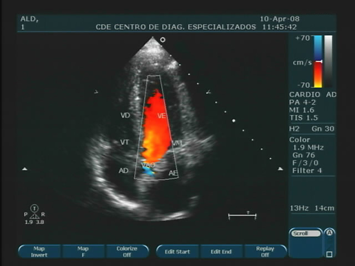 Ecocardiograma, Clinicor BD